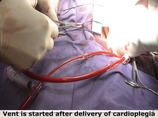 Vent is started after delivery of cardioplegia
 