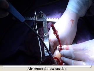 Air removal : use suction
 