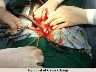 Removal of Cross Clamp
 