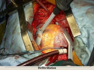 Defibrillation
 