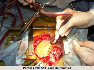 Partial CPB: SVC cannula removed
 