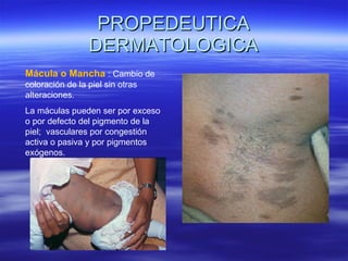 PROPEDEUTICA DERMATOLOGICA Mácula o Mancha   : Cambio de coloración de la piel sin otras alteraciones. La máculas pueden ser por exceso o por defecto del pigmento de la piel;  vasculares por congestión activa o pasiva y por pigmentos exógenos. 