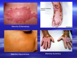 Mancha Eritematosa Mancha Hipocrómica Mancha Acrómica 