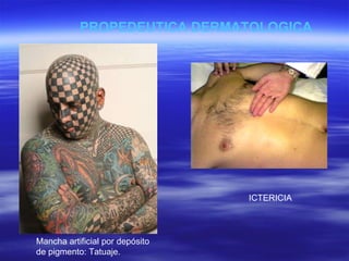 Mancha artificial por depósito de pigmento: Tatuaje. ICTERICIA PROPEDEUTICA DERMATOLOGICA 