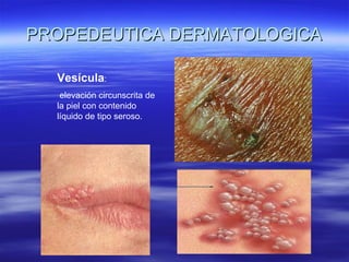PROPEDEUTICA DERMATOLOGICA Vesícula : elevación circunscrita de la piel con contenido líquido de tipo seroso. 