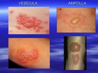VESÍCULA  AMPOLLA 