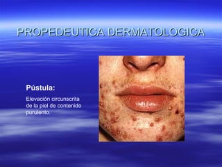 PROPEDEUTICA DERMATOLOGICA Pústula: Elevación circunscrita de la piel de contenido purulento. 