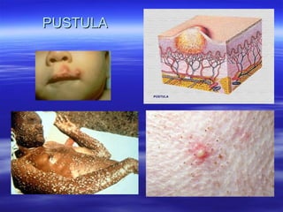PUSTULA 