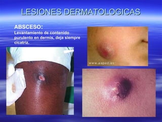 LESIONES DERMATOLOGICAS ABSCESO : Levantamiento de contenido purulento en dermis, deja siempre cicatriz. 