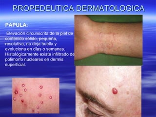 PROPEDEUTICA DERMATOLOGICA PAPULA : Elevación circunscrita de la piel de contenido sólido, pequeña, resolutiva, no deja huella y evoluciona en días o semanas. Histológicamente existe infiltrado de polimorfo nucleares en dermis superficial. 