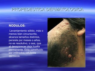 PROPEDEUTICA DERMATOLOGICA NODULOS : Levantamiento sólido, más o menos bien circunscrito, alcanza tamaños distintos, persiste por meses o años, no es resolutivo, o sea, que al desaparecer deja huella permanente. Esta constituido por infiltrados celulares dérmicos. 
