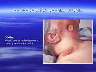 PROPEDEUTICA DERMATOLOGIA GOMA: Nódulo que se reblandece en su centro y se abre al exterior. 