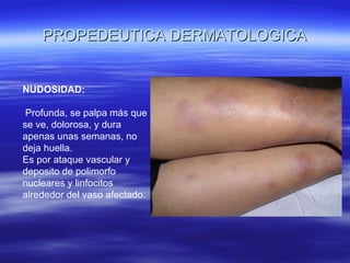 PROPEDEUTICA DERMATOLOGICA NUDOSIDAD: Profunda, se palpa más que se ve, dolorosa, y dura apenas unas semanas, no deja huella. Es por ataque vascular y deposito de polimorfo nucleares y linfocitos alrededor del vaso afectado. 
