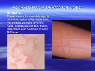 PROPEDEUTICA DERMATOLOGICA RONCHA :  Edema vasomotor a nivel de dermis originando lesión solida, superficial, mal definida de todos tamaños; fugaz, desaparece sin dejar huella. Caracteriza a un síndrome llamado  Urticaria . 
