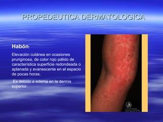 PROPEDEUTICA DERMATOLOGICA Habón : Elevación cutánea en ocasiones pruriginosa, de color rojo pálido de característica superficie redondeada o aplanada y evanescente en el espacio de pocas horas. Es debido a edema en la dermis superior. 