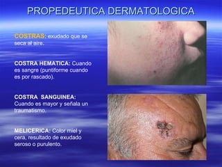 PROPEDEUTICA DERMATOLOGICA COSTRAS :  exudado que se seca al aire. COSTRA HEMATICA:  Cuando es sangre (puntiforme cuando es por rascado). COSTRA  SANGUINEA:  Cuando es mayor y señala un traumatismo. MELICERICA:  Color miel y cera, resultado de exudado seroso o purulento. 
