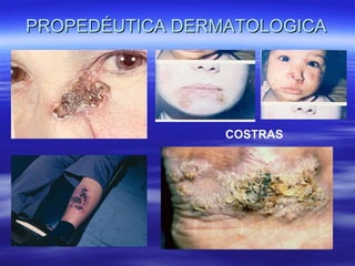 PROPEDÉUTICA DERMATOLOGICA COSTRAS 