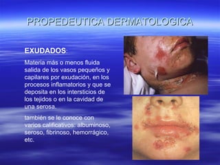 PROPEDEUTICA DERMATOLOGICA EXUDADOS :  Materia más o menos fluida salida de los vasos pequeños y capilares por exudación, en los procesos inflamatorios y que se deposita en los intersticios de los tejidos o en la cavidad de una serosa.  también se le conoce con varios calificativos: albuminoso, seroso, fibrinoso, hemorrágico, etc. 