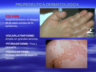 PROPEDEUTICA DERMATOLOGICA ESCAMA : Desprendimiento en bloque de la capa cornea de la epidermis. ESCARLATINIFORME:  Amplia en grandes laminas. PITIRIASIFORME:  Fina y pequeña. PSORIASIFORME:  Gruesa; blanca de aspecto yesoso. 