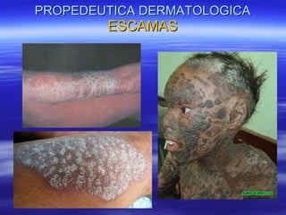 PROPEDEUTICA DERMATOLOGICA  ESCAMAS 