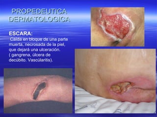 PROPEDEUTICA DERMATOLOGICA ESCARA: Caída en bloque de una parte muerta, necrosada de la piel, que dejará una ulceración.  ( gangrena, úlcera de decúbito. Vascúlaritis). 