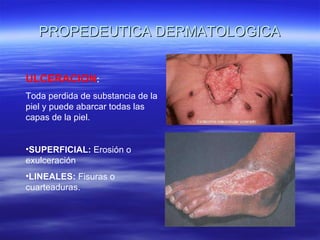 PROPEDEUTICA DERMATOLOGICA ULCERACION :  Toda perdida de substancia de la piel y puede abarcar todas las capas de la piel. SUPERFICIAL:  Erosión o exulceración LINEALES:  Fisuras o cuarteaduras. 