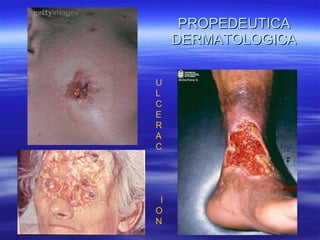 PROPEDEUTICA DERMATOLOGICA ULCERAC  I ON  