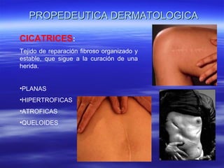PROPEDEUTICA DERMATOLOGICA CICATRICES :  Tejido de reparación fibroso organizado y estable, que sigue a la curación de una herida. PLANAS HIPERTROFICAS  ATROFICAS QUELOIDES 