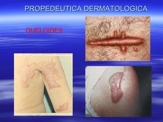 PROPEDEUTICA DERMATOLOGICA QUELOIDES 