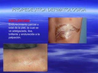 PROPEDEUTICA DERMATOLOGICA ESCLEROSIS :  Endurecimiento parcial o total de la piel, la cual se ve adelgazada, lisa, brillante y endurecida a la palpación. 