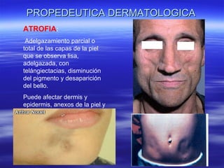 PROPEDEUTICA DERMATOLOGICA ATROFIA : Adelgazamiento parcial o total de las capas de la piel que se observa lisa, adelgazada, con telángiectacias, disminución del pigmento y desaparición del bello. Puede afectar dermis y epidermis, anexos de la piel y tejido celular subcutáneo. 