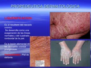 PROPEDEUTICA DERMATOLOGICA LIQUENIFICACION: Es el resultado del rascado crónico. Se desarrolla como una exageración de las líneas normales y del cuadrado romboidal de la piel. Es la lesión elemental de las dermatitis crónica pruriginosas. PAQUIDERMIA : Piel de elefante. 