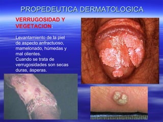 PROPEDEUTICA DERMATOLOGICA VERRUGOSIDAD Y VEGETACION :  Levantamiento de la piel de aspecto anfractuoso, mamelonado, húmedas y mal olientes. Cuando se trata de verrugosidades son secas duras, ásperas. 