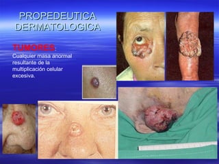 PROPEDEUTICA DERMATOLOGICA TUMORES : Cualquier masa anormal resultante de la multiplicación celular excesiva. 