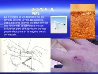 BIOPSIA  DE PIEL Es el estudio de un fragmento de piel tomado durante la vida del paciente. Debe indicarse cuando los datos clínicos que nos brinda la dermatosis no son suficientes para el diagnóstico, aunque puede efectuarse en la mayoría de las dermatosis. 