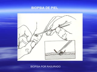 BIOPSIA DE PIEL BIOPSIA POR RASURADO 