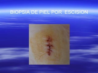 BIOPSIA DE PIEL POR  ESCISION 