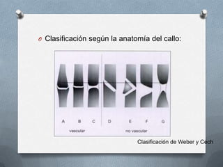O Clasificación según la anatomía del callo:
Clasificación de Weber y Cech
 