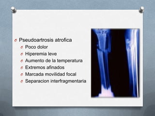 O Pseudoartrosis atrofica
O Poco dolor
O Hiperemia leve
O Aumento de la temperatura
O Extremos afinados
O Marcada movilidad focal
O Separacion interfragmentaria
 