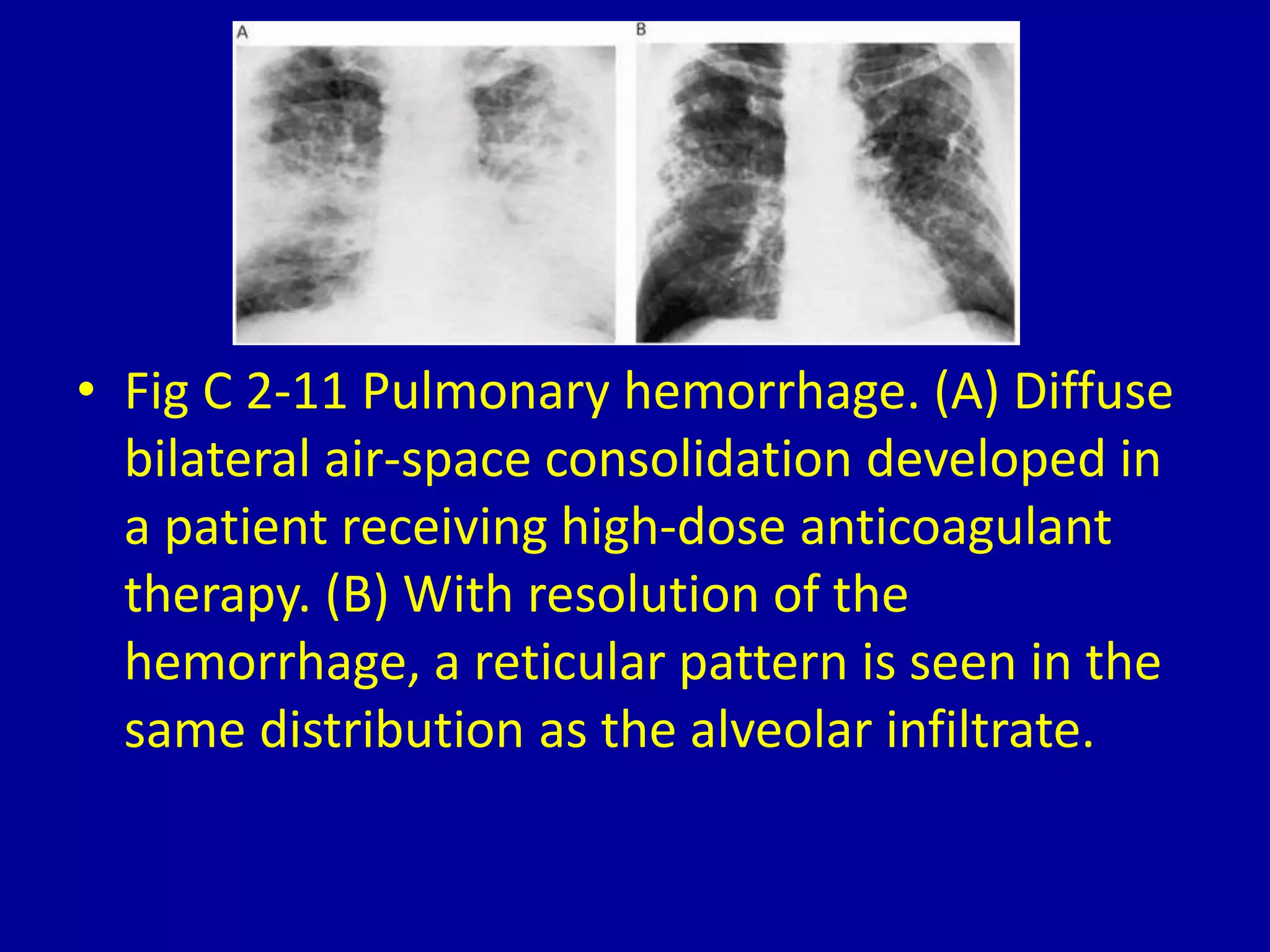 Alveolar Pattern Rcc 2 pulmonary edema pattern (symmetric bilateral alveolar | PPTX