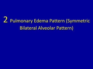 2 Pulmonary Edema Pattern (Symmetric
Bilateral Alveolar Pattern)
 