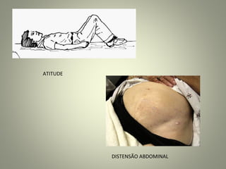 DISTENSÃO ABDOMINAL
ATITUDE
 
