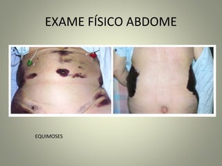 EXAME FÍSICO ABDOME
EQUIMOSES
 