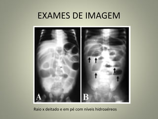 EXAMES DE IMAGEM
Raio x deitado e em pé com níveis hidroaéreos
 