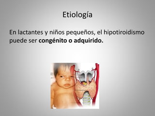 Etiología
En lactantes y niños pequeños, el hipotiroidismo
puede ser congénito o adquirido.
 