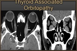 Thyroid Associated
Orbitopathy
 