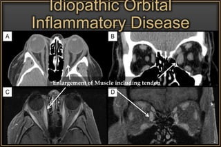 Idiopathic Orbital
Inflammatory Disease
Enlargement of Muscle including tendon
 