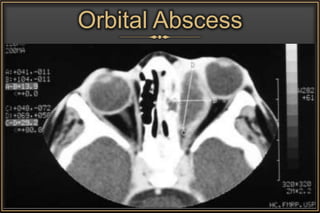 Orbital Abscess
 