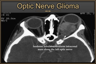 Optic Nerve Glioma
Isodense lobulated fusiform intraconal
mass along the left optic nerve
 