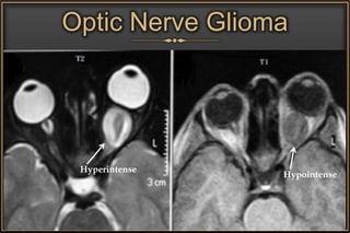 Optic Nerve Glioma
Hyperintense
Hypointense
 